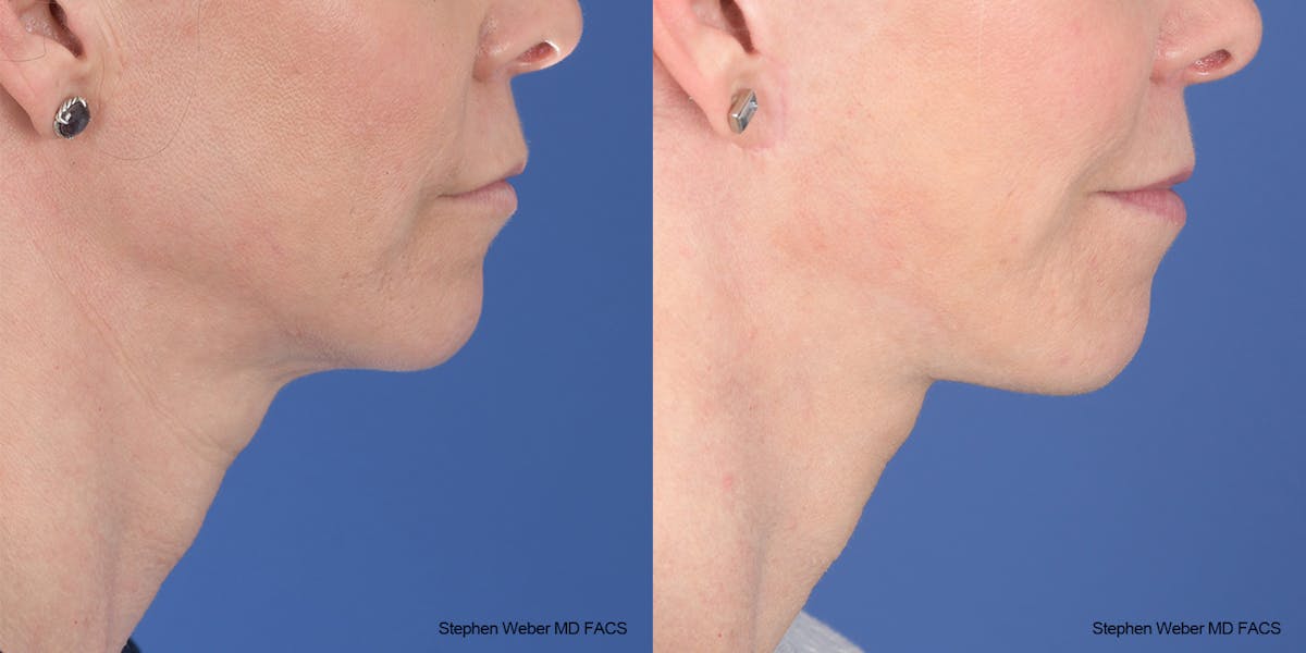Facelift Before & After Gallery - Patient 343325 - Image 4