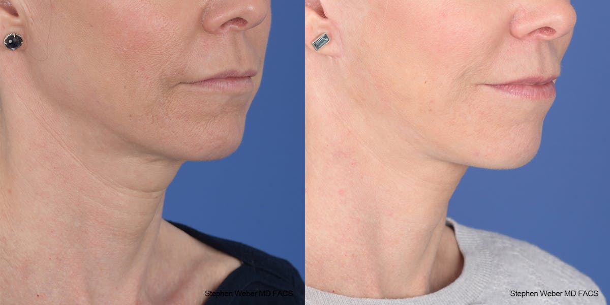 Facelift Before & After Gallery - Patient 343325 - Image 5