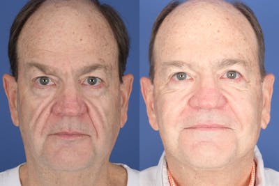 Facelift Before & After Gallery - Patient 119890 - Image 1
