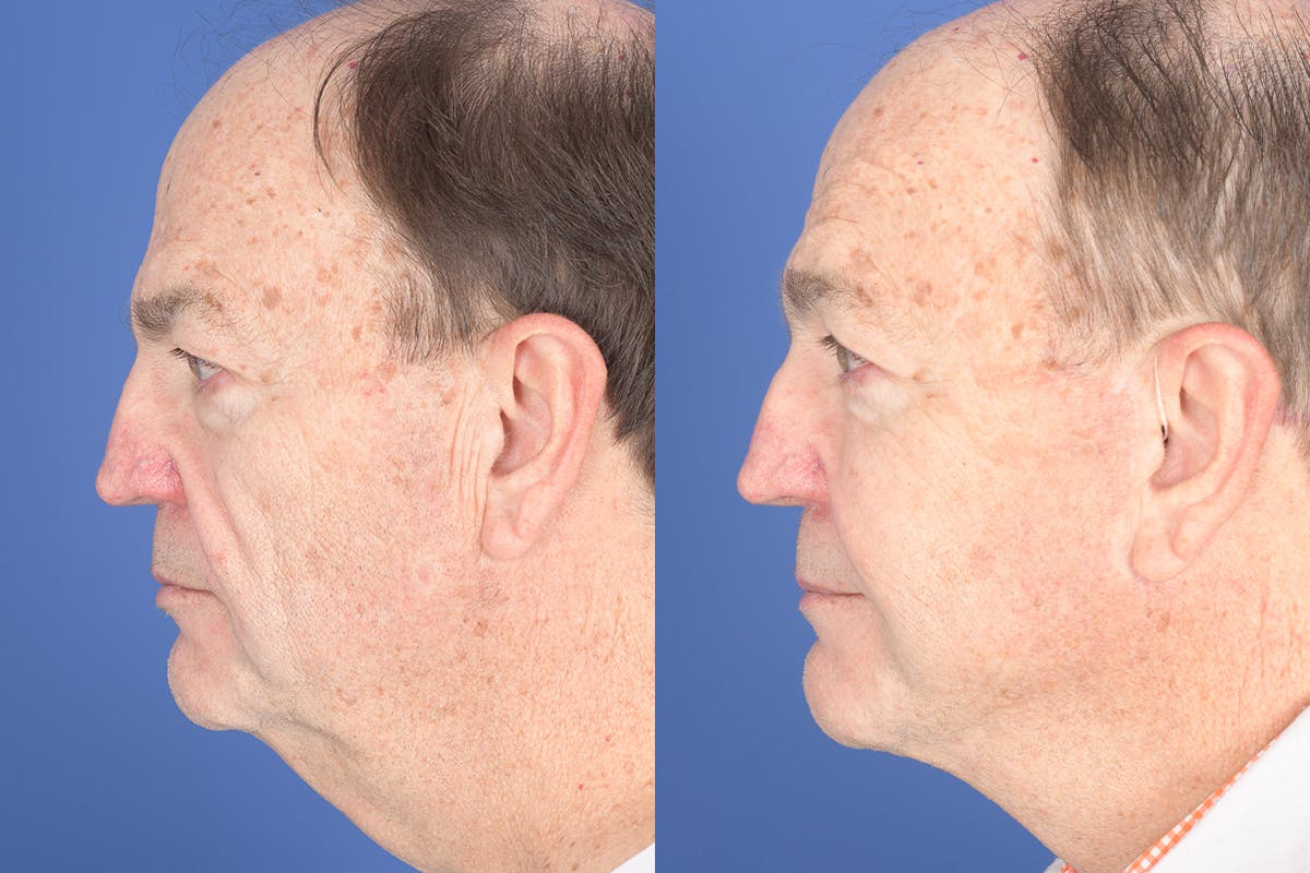 Facelift Before & After Gallery - Patient 119890 - Image 2