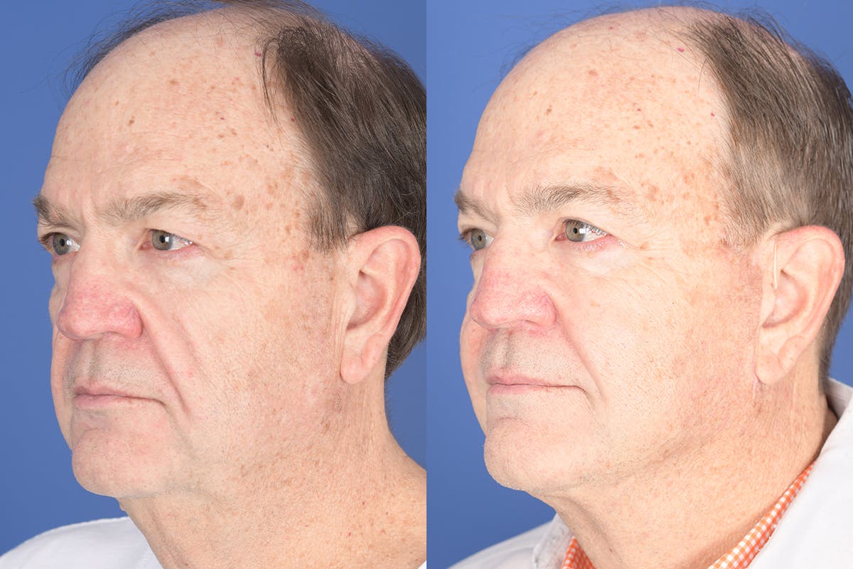 Facelift Before & After Gallery - Patient 119890 - Image 3