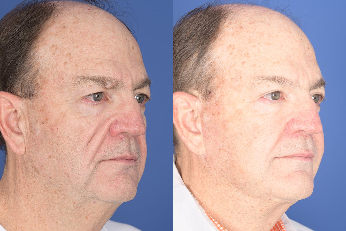 Facelift Before & After Gallery - Patient 119890 - Image 4