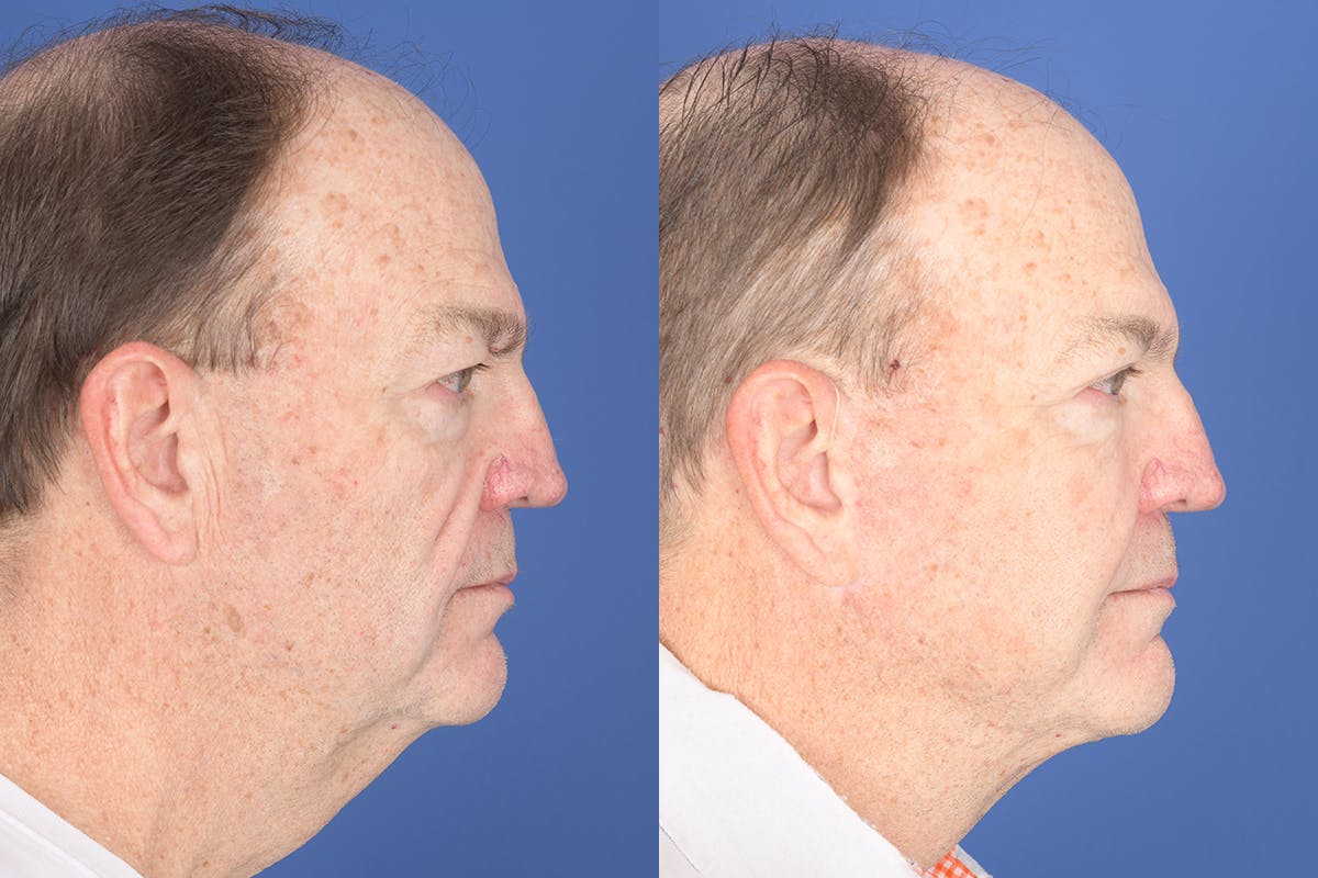 Facelift Before & After Gallery - Patient 119890 - Image 5