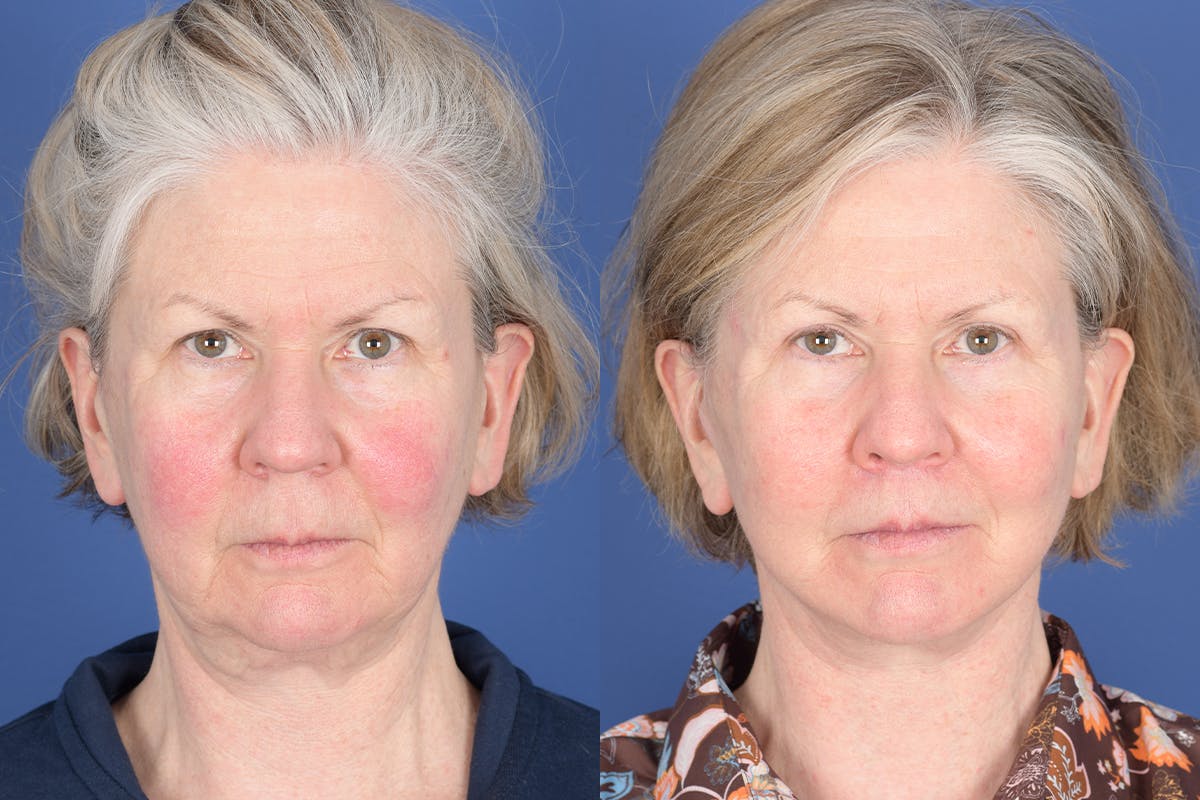 Facelift Before & After Gallery - Patient 403313 - Image 1
