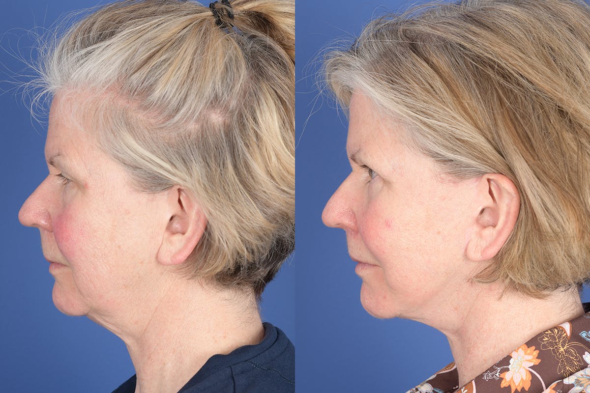Facelift Before & After Gallery - Patient 403313 - Image 2
