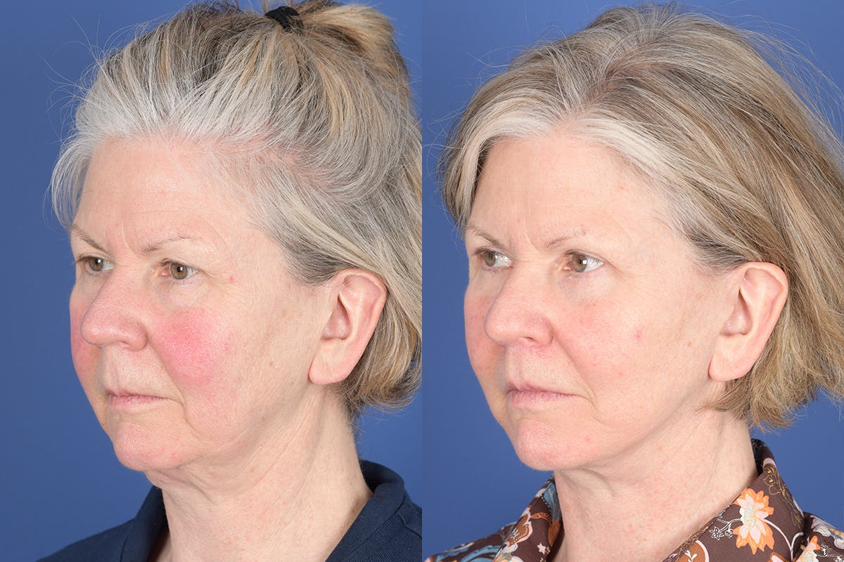 Facelift Before & After Gallery - Patient 403313 - Image 3