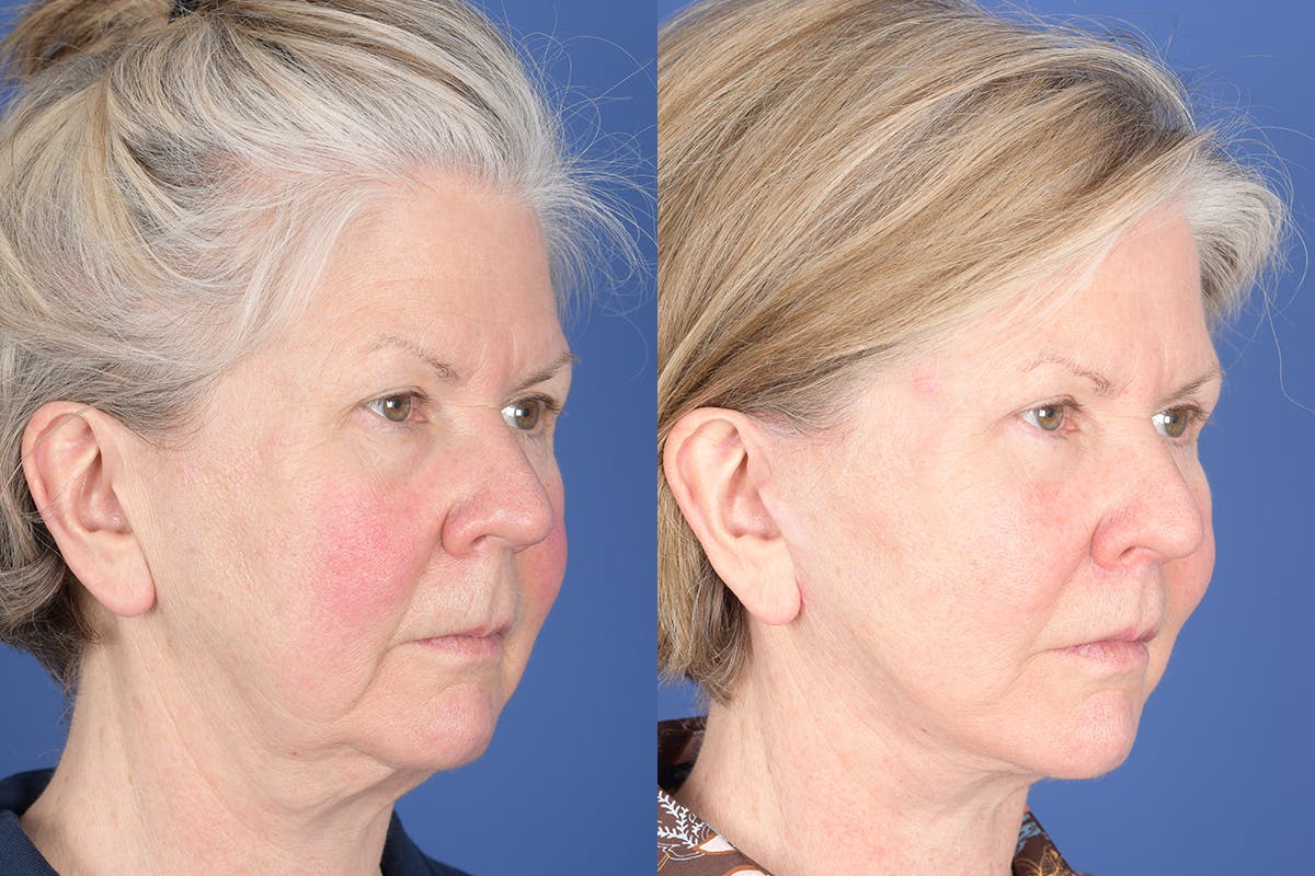 Facelift Before & After Gallery - Patient 403313 - Image 4