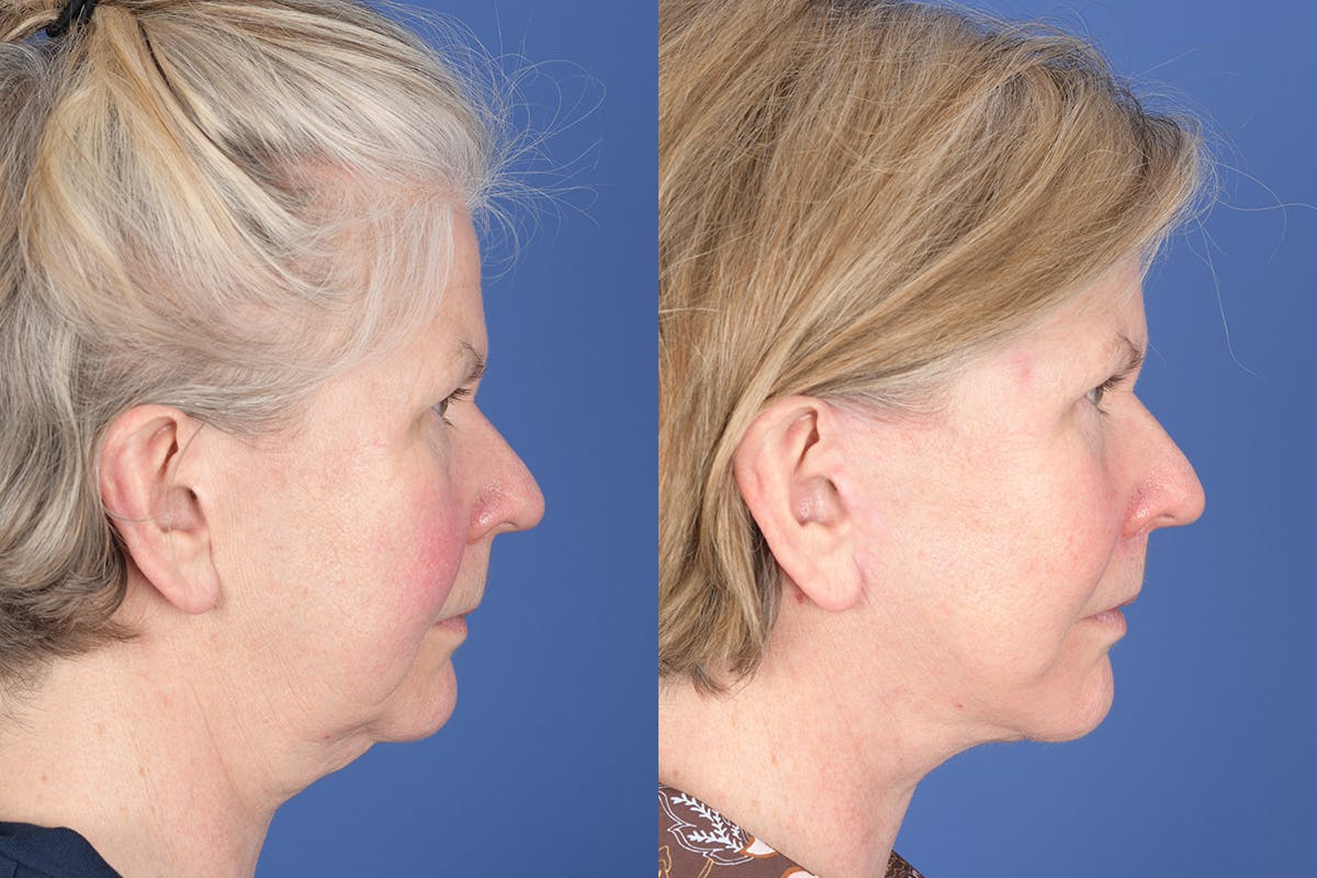 Facelift Before & After Gallery - Patient 403313 - Image 5