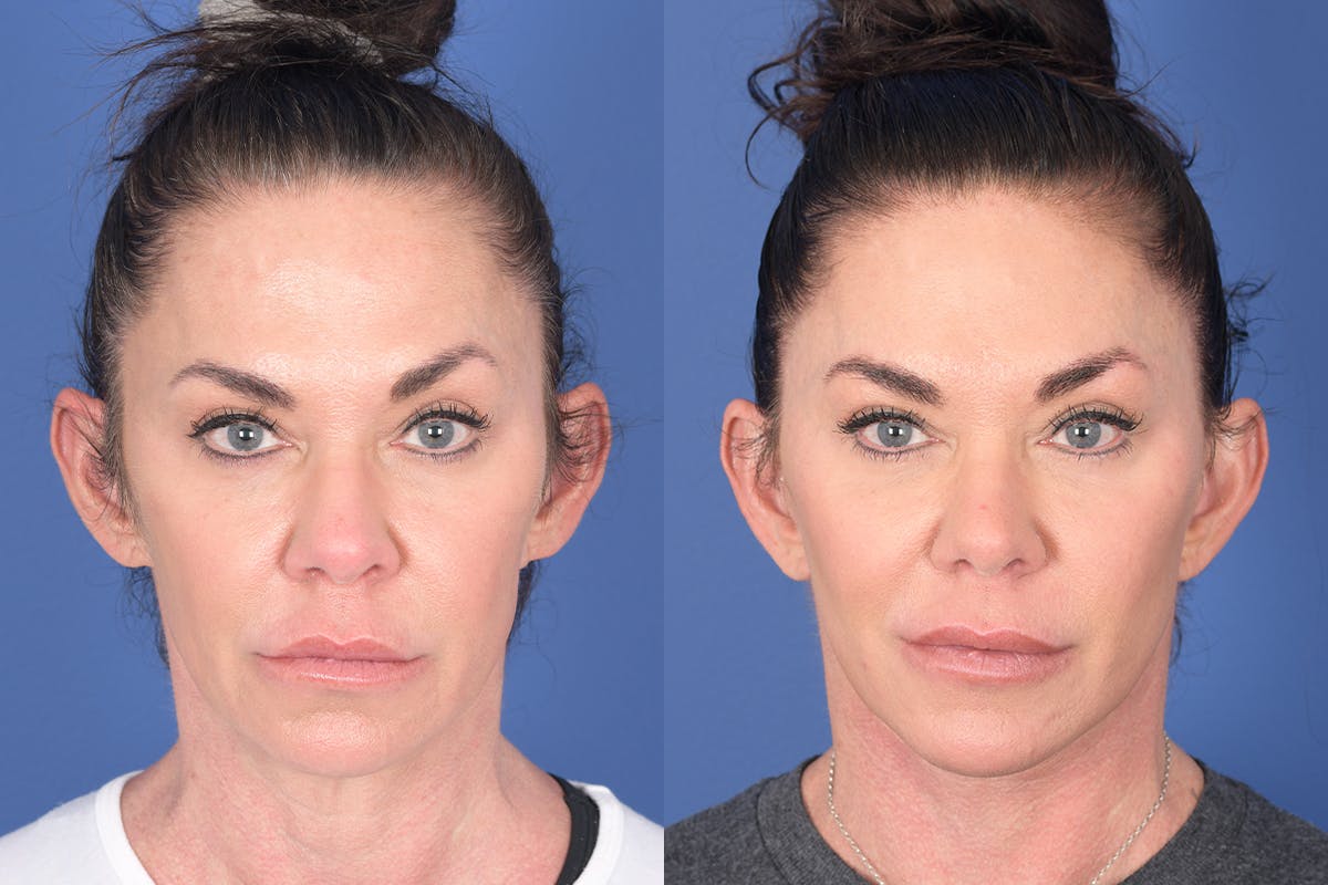 Facelift Before & After Gallery - Patient 272749 - Image 1