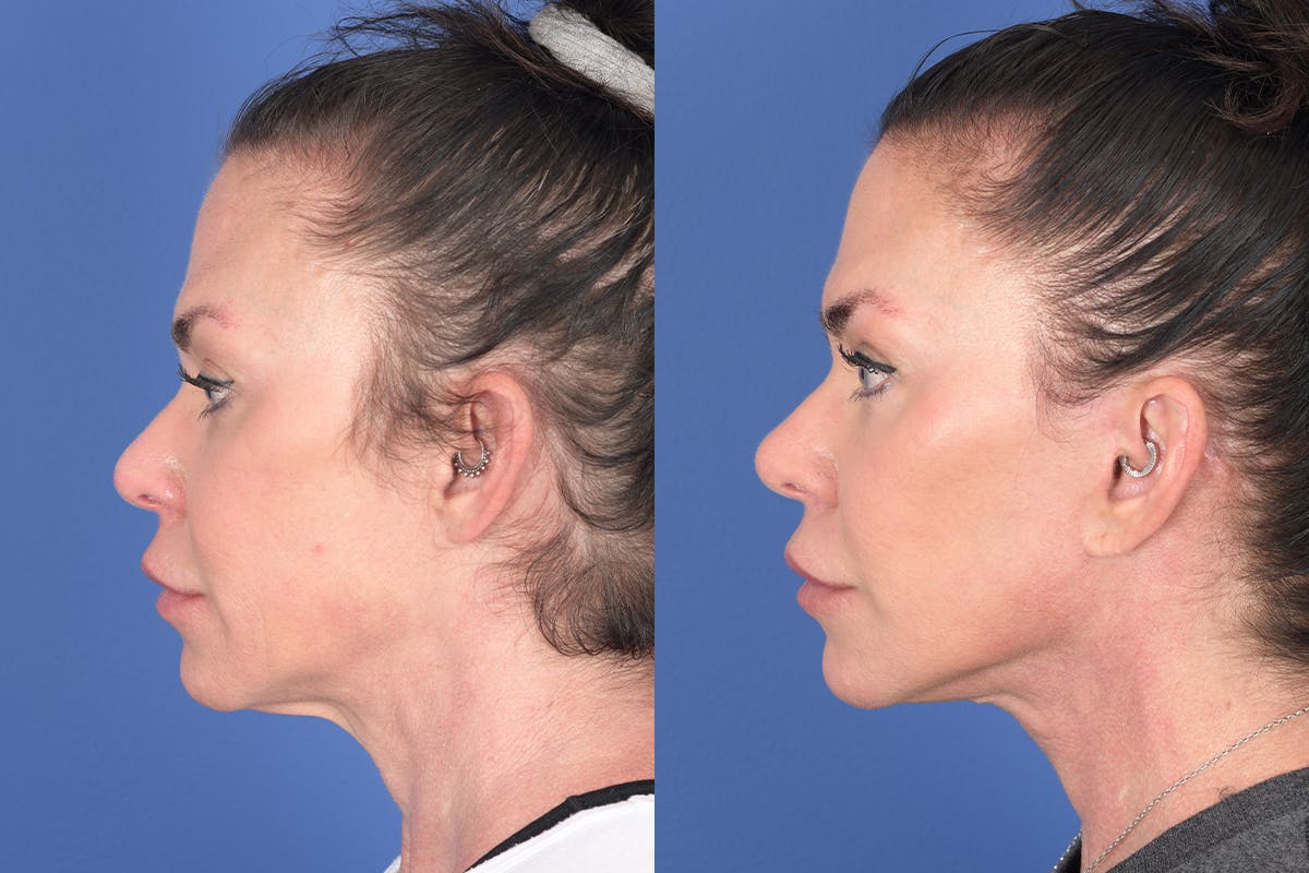Facelift Before & After Gallery - Patient 272749 - Image 2