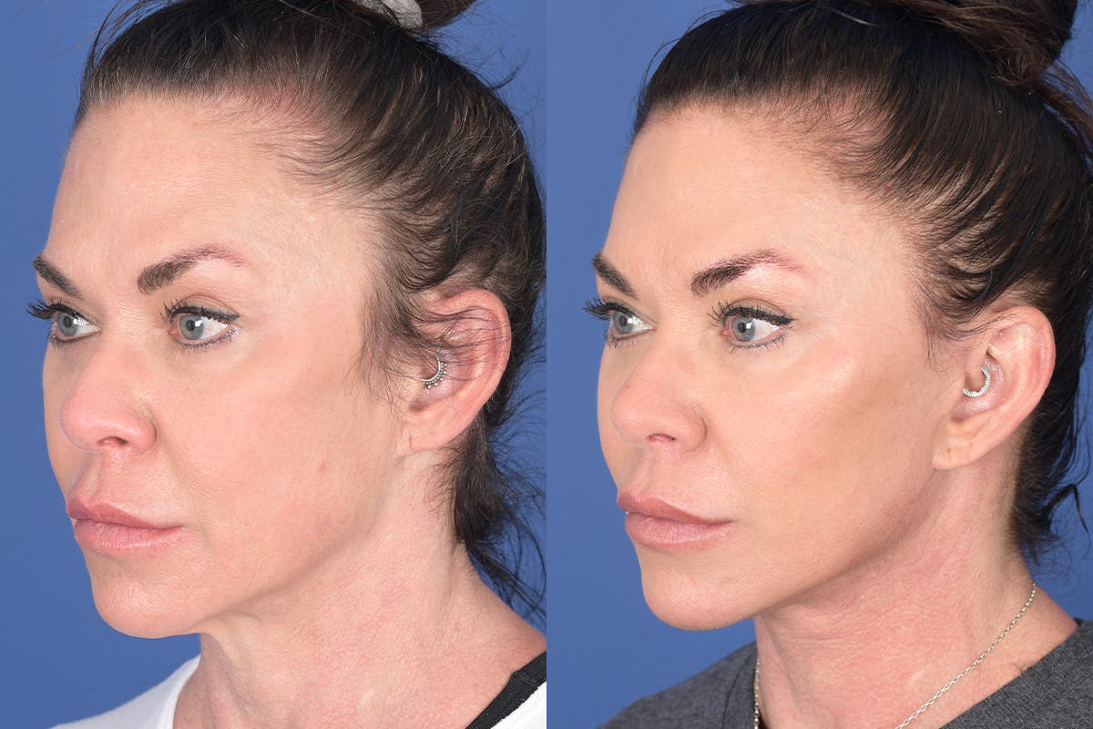 Facelift Before & After Gallery - Patient 272749 - Image 3