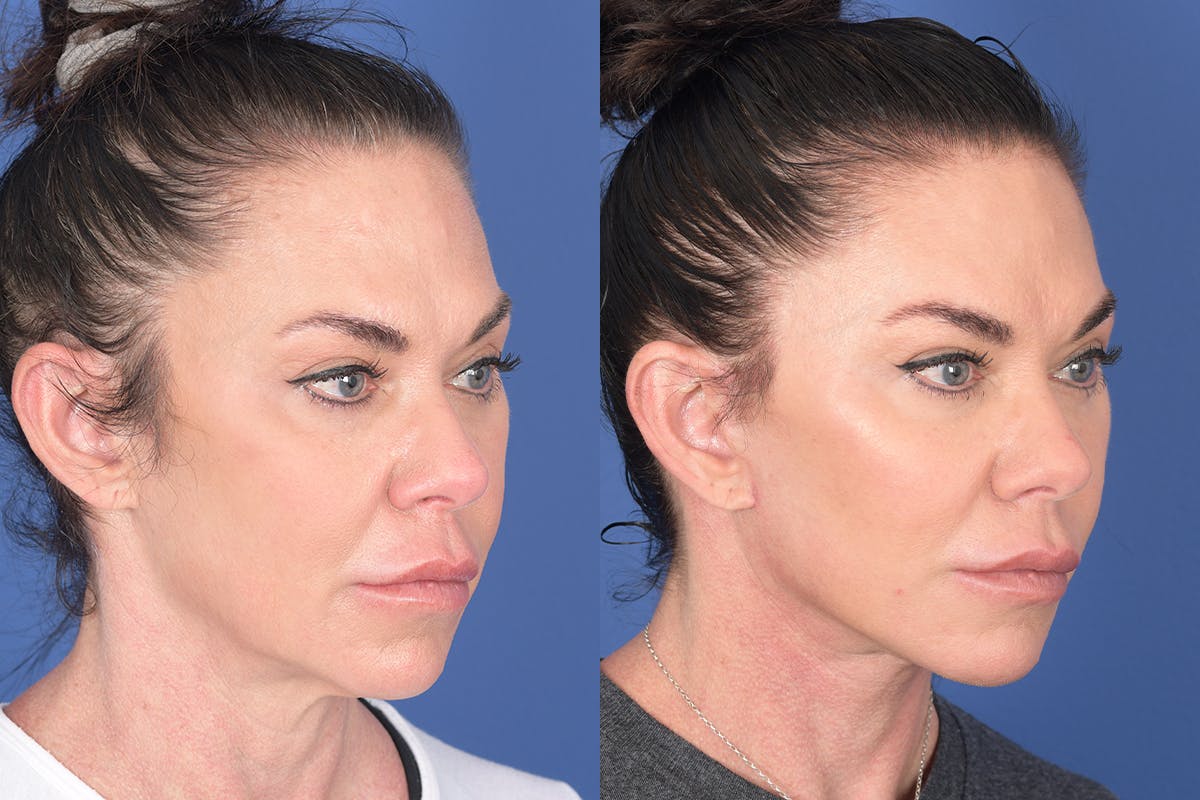 Facelift Before & After Gallery - Patient 272749 - Image 4