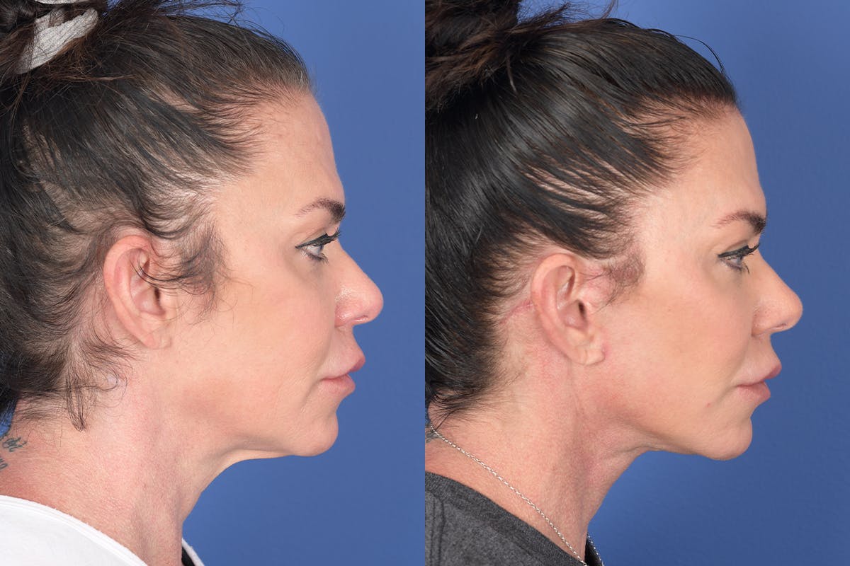 Facelift Before & After Gallery - Patient 272749 - Image 5