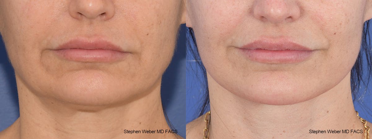 Facelift Before & After Gallery - Patient 117659 - Image 1