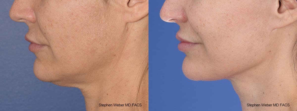 Facelift Before & After Gallery - Patient 117659 - Image 2