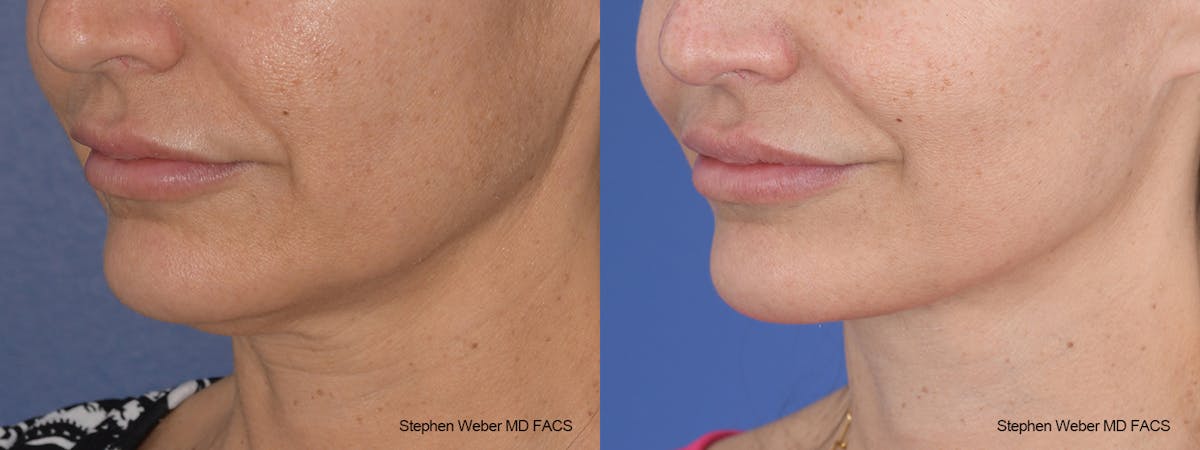 Facelift Before & After Gallery - Patient 117659 - Image 3