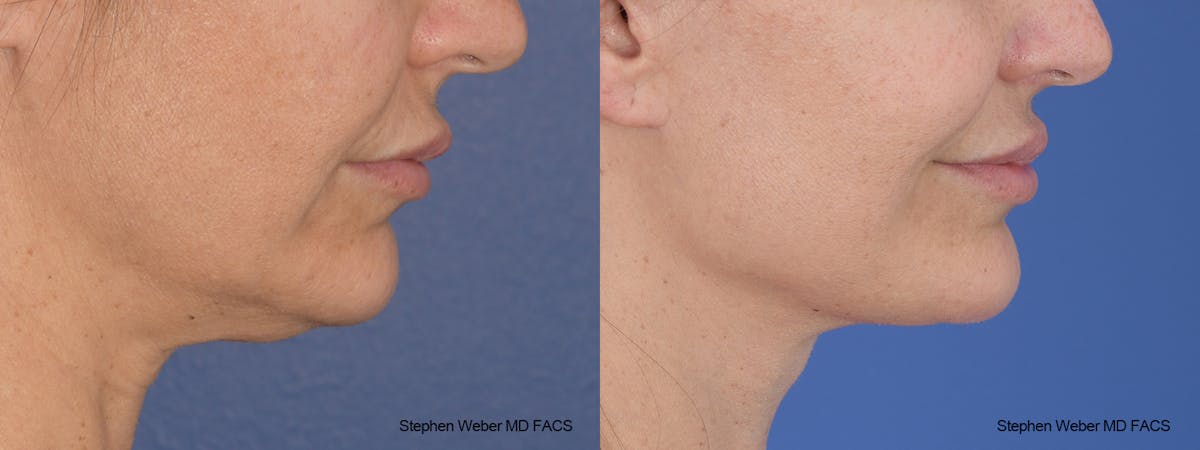 Facelift Before & After Gallery - Patient 117659 - Image 4