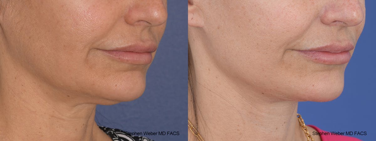 Facelift Before & After Gallery - Patient 117659 - Image 5