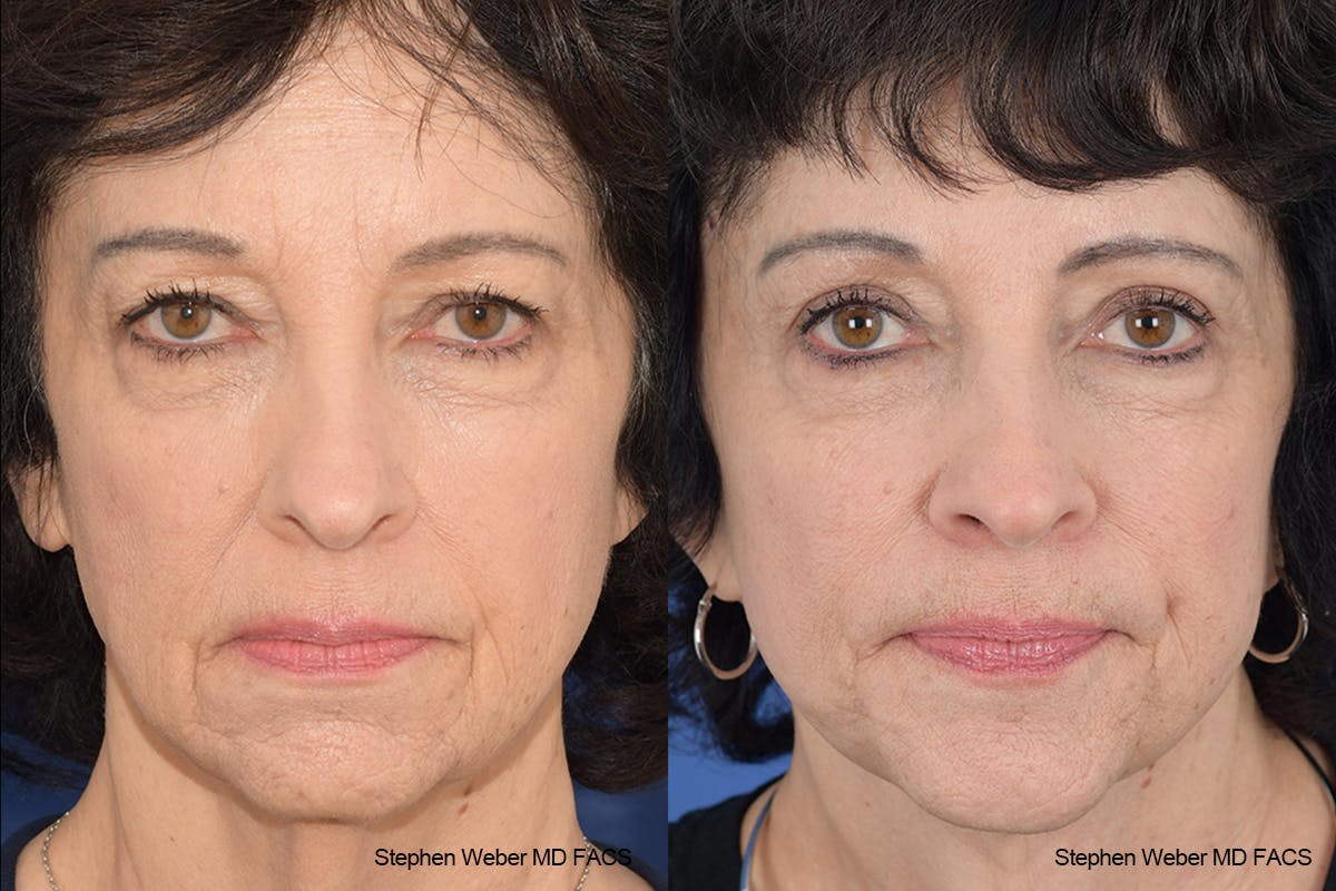 Facelift Before & After Gallery - Patient 137078 - Image 1