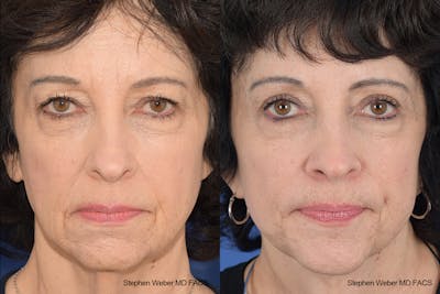 Facelift Before & After Gallery - Patient 137078 - Image 1