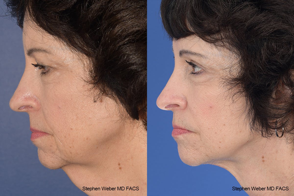 Facelift Before & After Gallery - Patient 137078 - Image 2