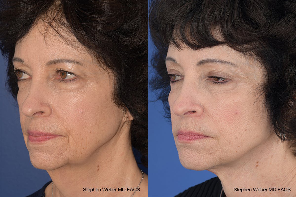 Facelift Before & After Gallery - Patient 137078 - Image 3