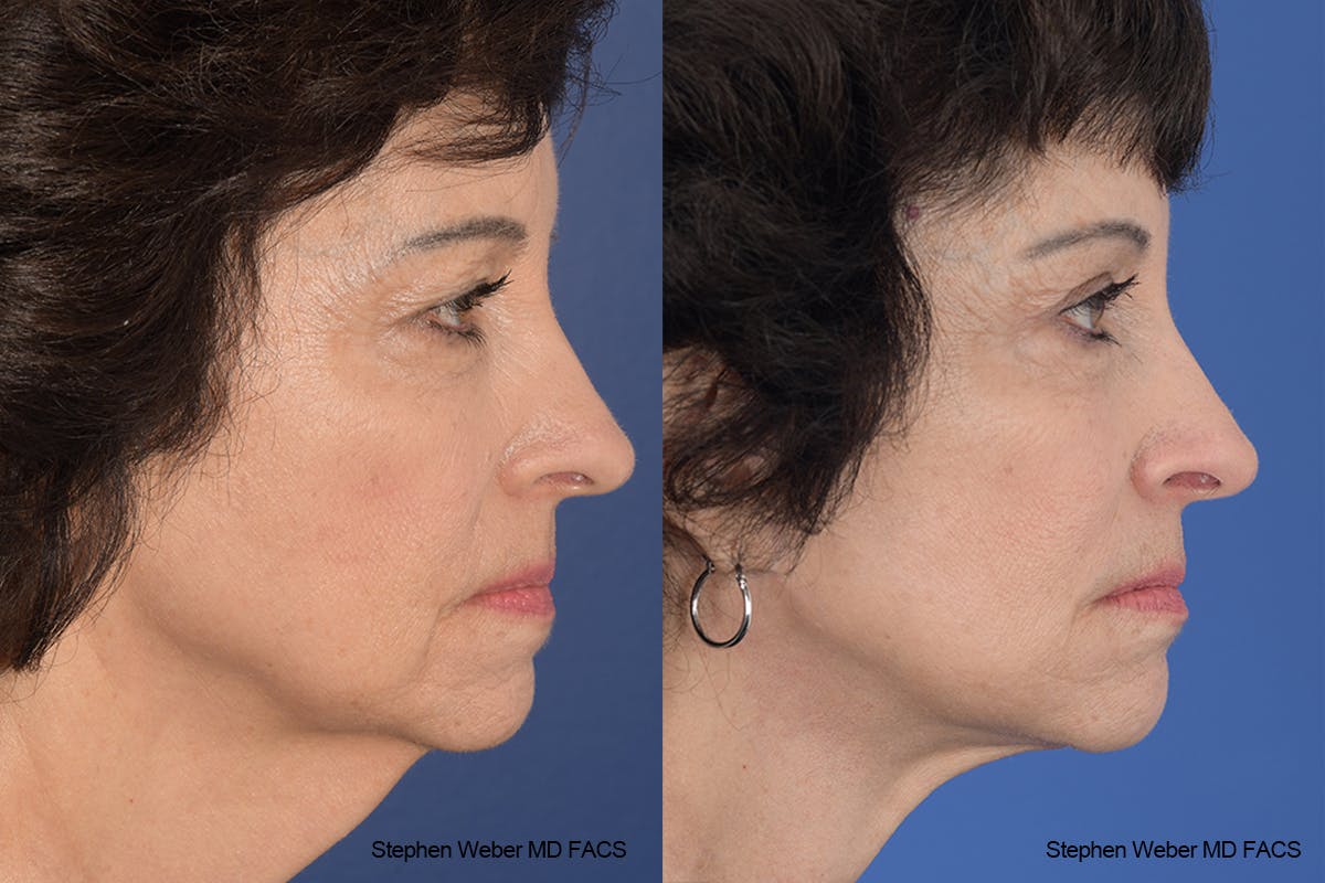 Facelift Before & After Gallery - Patient 137078 - Image 4