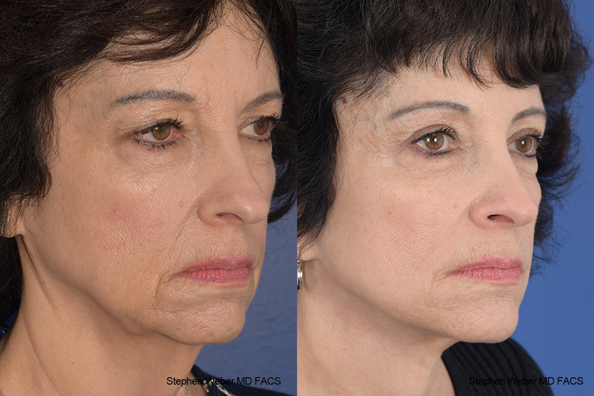 Facelift Before & After Gallery - Patient 137078 - Image 5