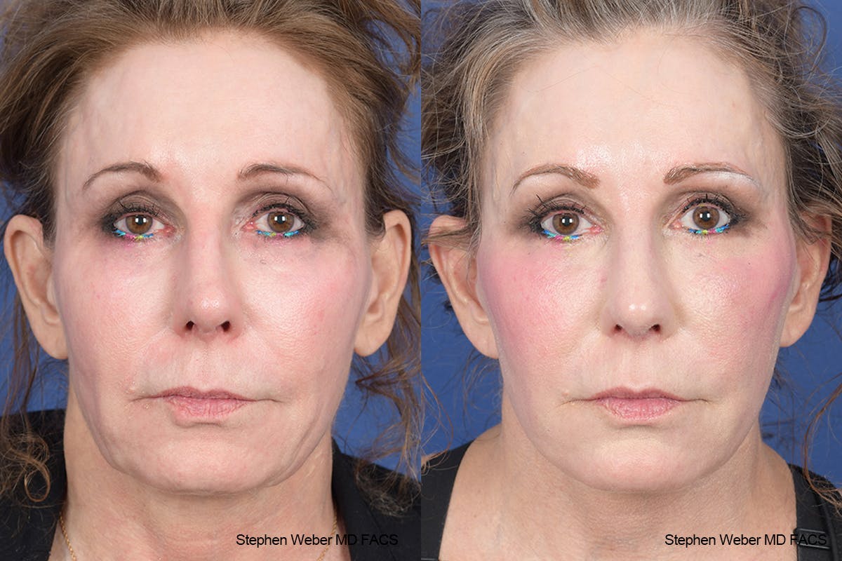 Facelift Before & After Gallery - Patient 126067 - Image 1
