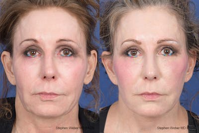 Facelift Before & After Gallery - Patient 126067 - Image 1