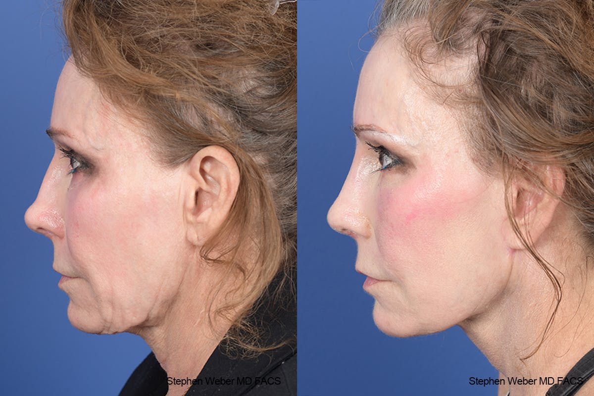 Facelift Before & After Gallery - Patient 126067 - Image 2