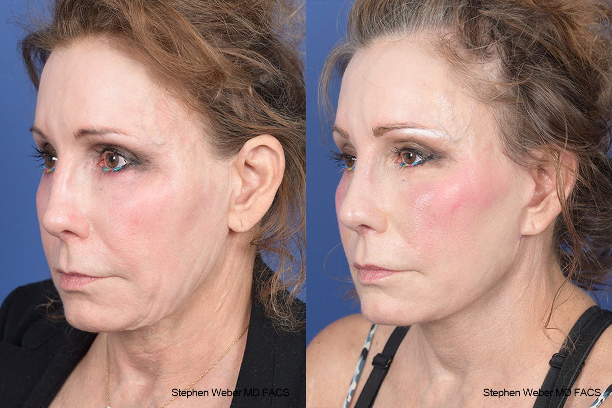 Facelift Before & After Gallery - Patient 126067 - Image 3
