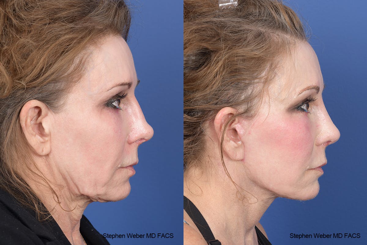 Facelift Before & After Gallery - Patient 126067 - Image 4