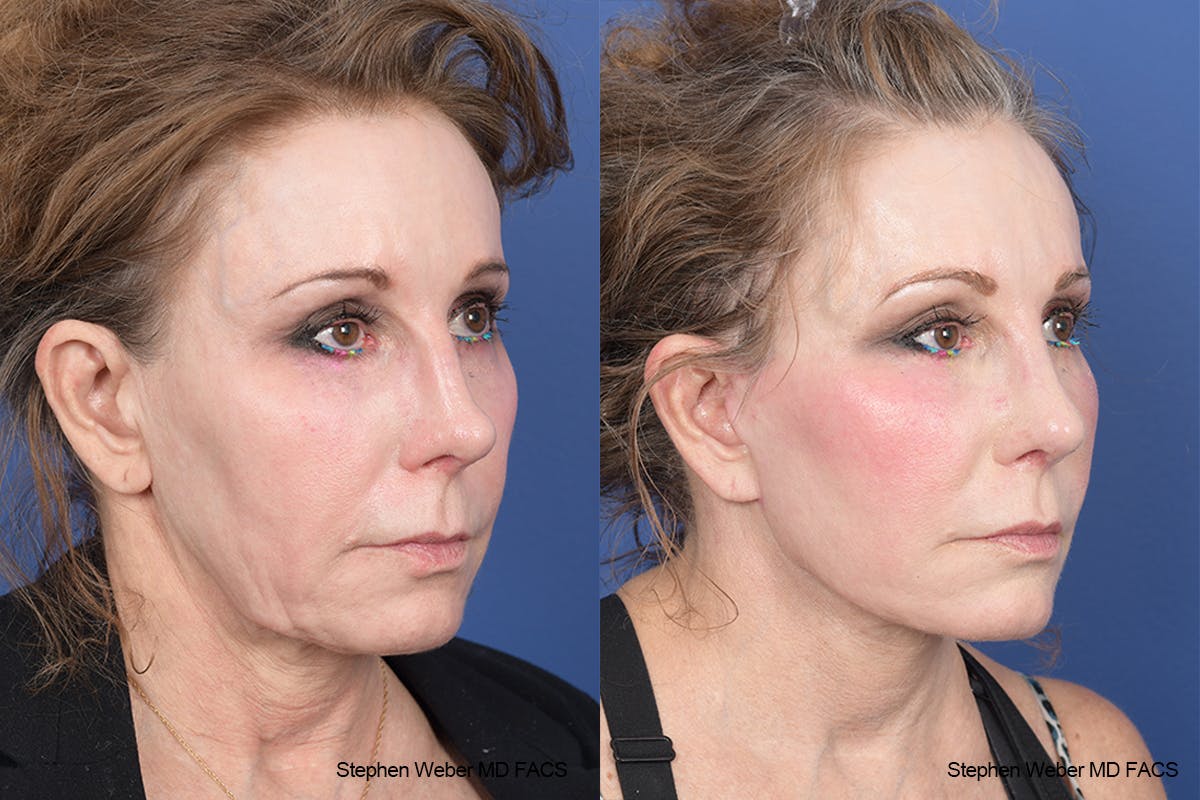 Facelift Before & After Gallery - Patient 126067 - Image 5