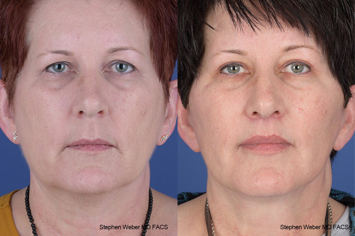 Facelift Before & After Gallery - Patient 418596 - Image 1