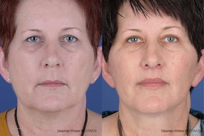 Facelift Before & After Gallery - Patient 418596 - Image 1
