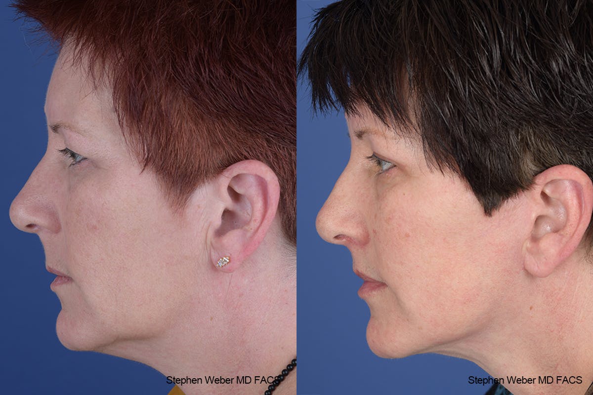 Facelift Before & After Gallery - Patient 418596 - Image 2