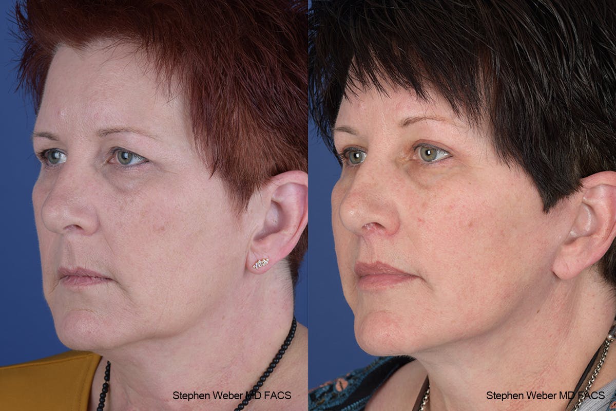 Facelift Before & After Gallery - Patient 418596 - Image 3