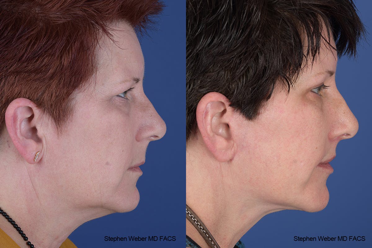 Facelift Before & After Gallery - Patient 418596 - Image 4