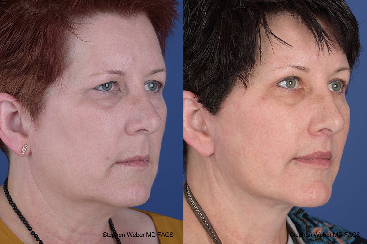 Facelift Before & After Gallery - Patient 418596 - Image 5