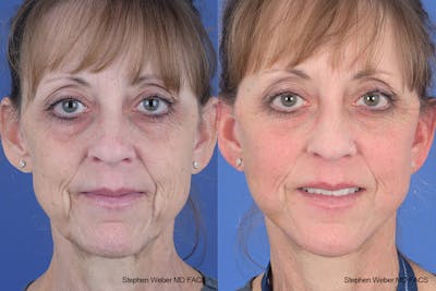 Facelift Before & After Gallery - Patient 310170 - Image 1