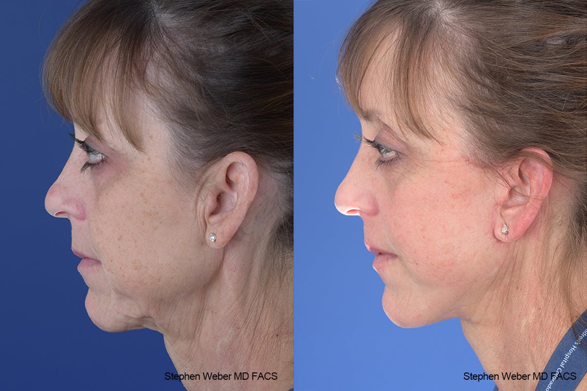 Facelift Before & After Gallery - Patient 310170 - Image 2