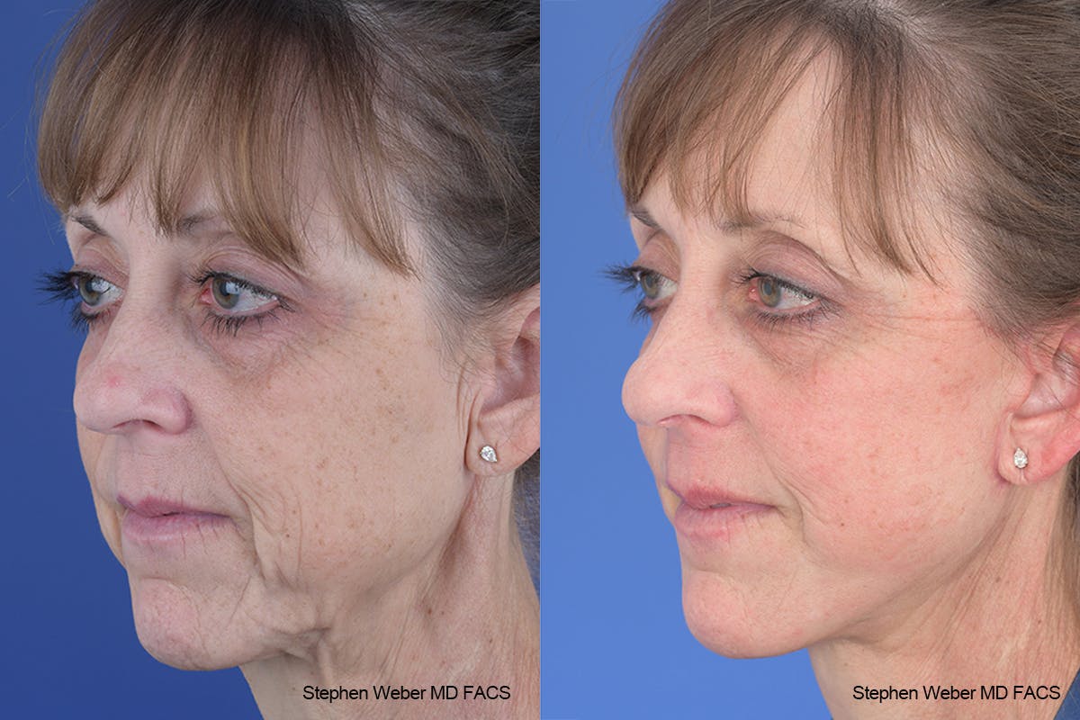 Facelift Before & After Gallery - Patient 310170 - Image 3