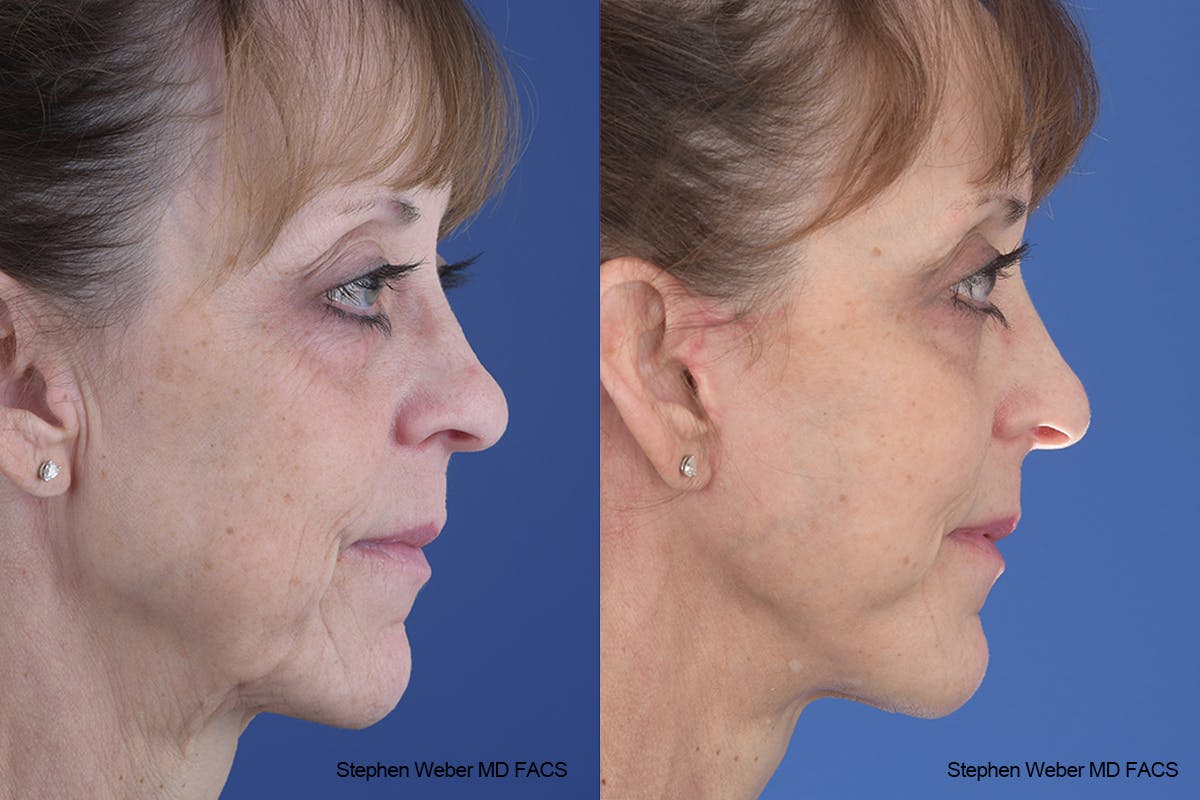 Facelift Before & After Gallery - Patient 310170 - Image 4