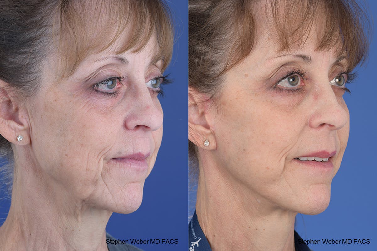 Facelift Before & After Gallery - Patient 310170 - Image 5