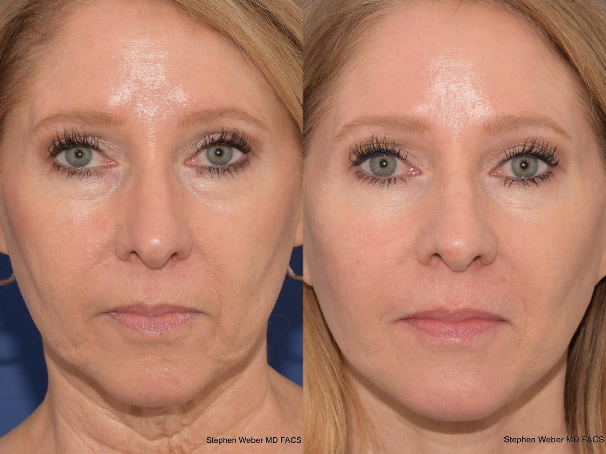 Facelift Before & After Gallery - Patient 330443 - Image 1