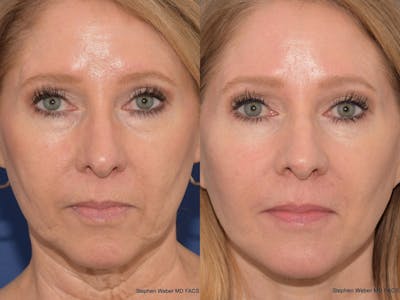 Facelift Before & After Gallery - Patient 330443 - Image 1