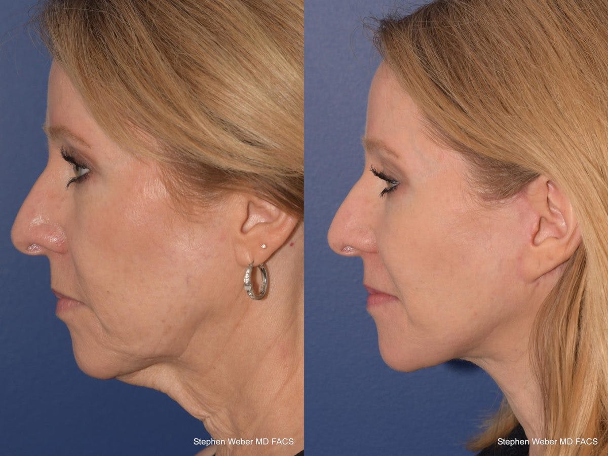 Facelift Before & After Gallery - Patient 330443 - Image 2