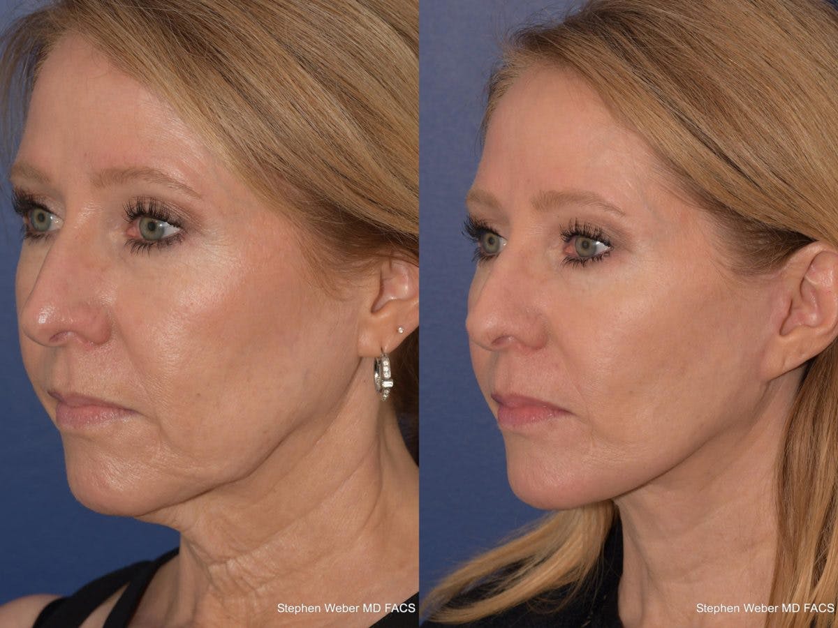 Facelift Before & After Gallery - Patient 330443 - Image 3