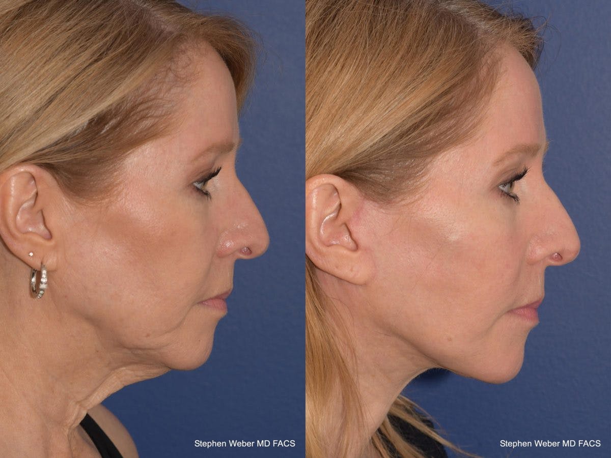 Facelift Before & After Gallery - Patient 330443 - Image 4